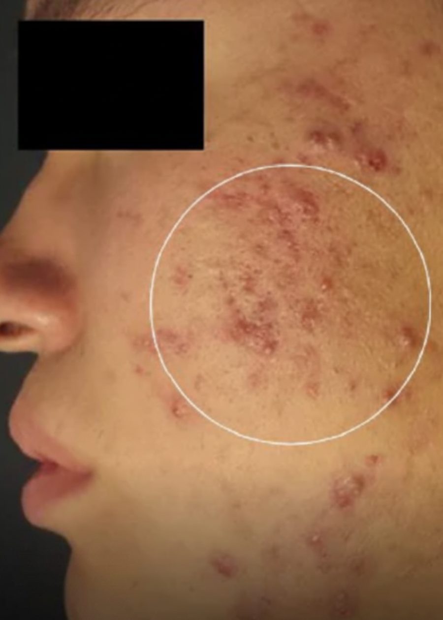 ACNE SCARS & PORES