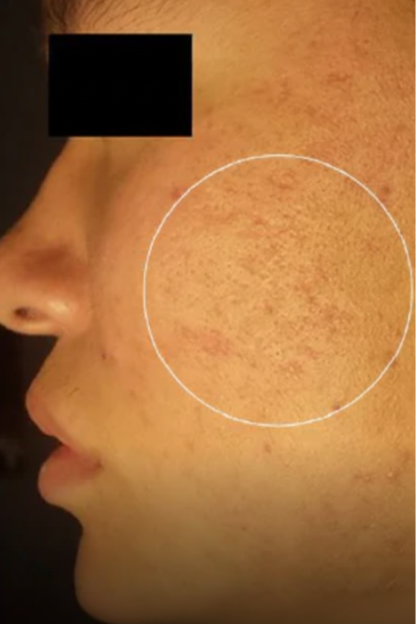ACNE SCARS & PORES