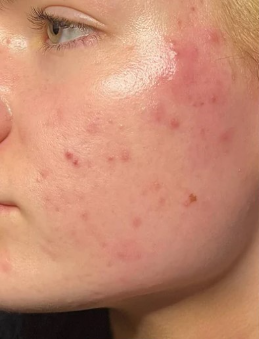 ACTIVE ACNE & REDNESS