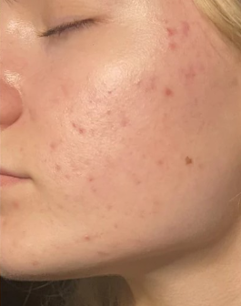 ACTIVE ACNE & REDNESS