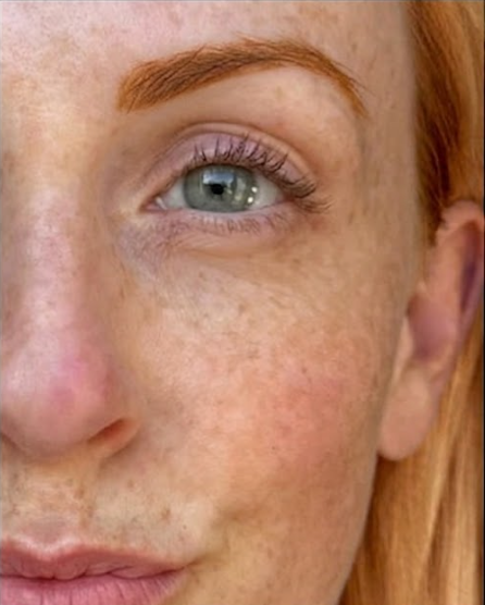 DARK CIRCLES & EYE FATIGUE