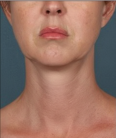 NECK LINES & DOUBLE CHIN