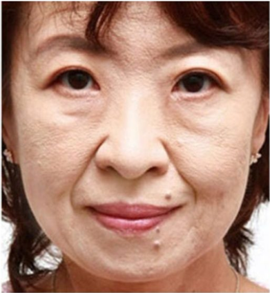 FOREHEAD LINES & WRINKLES