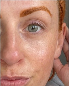 DARK CIRCLES & EYE FATIGUE