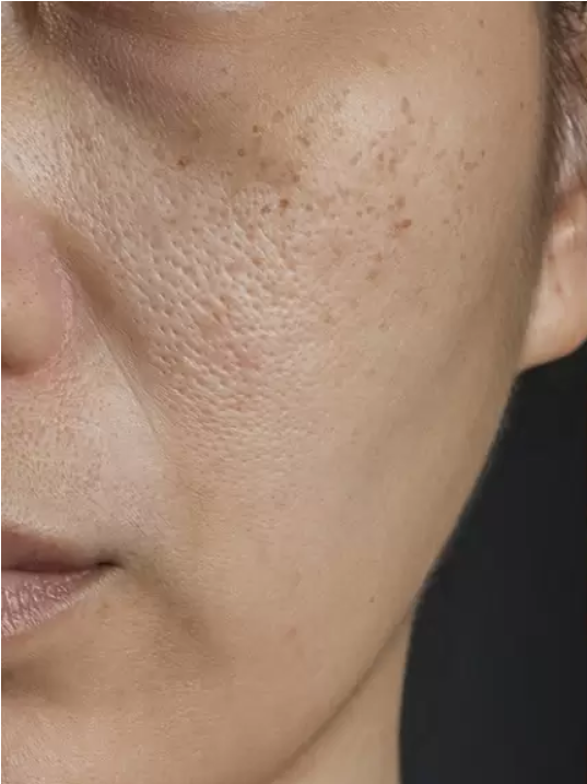 ENLARGED PORES