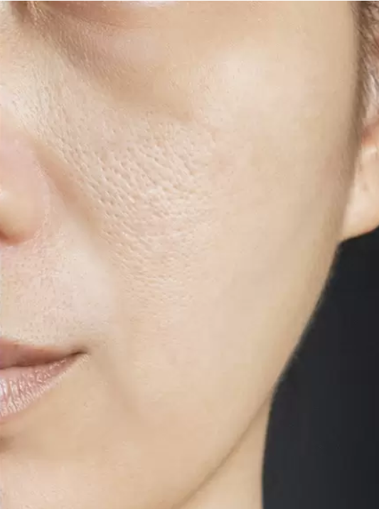 ENLARGED PORES