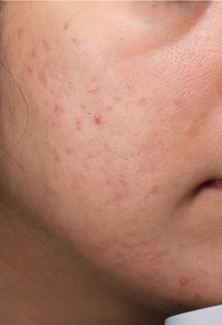 ACTIVE BREAKOUTS